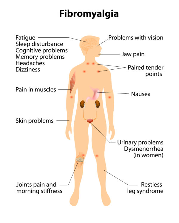 fibromyalgia treatment Visalia