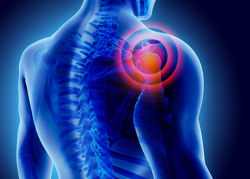 shoulder impingement treatment in Visalia