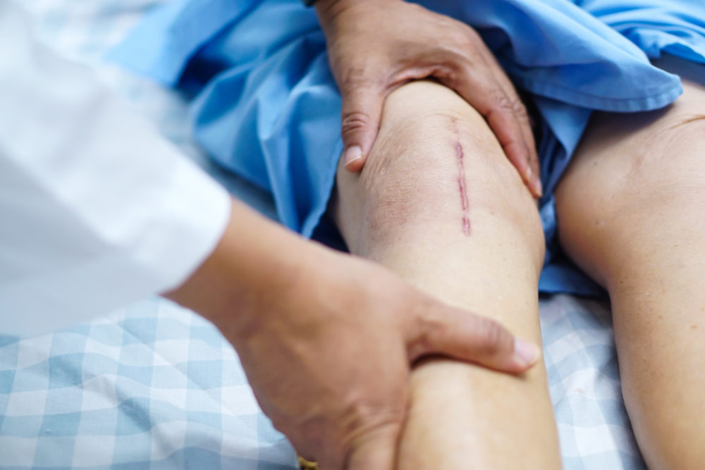 Physical Therapy After Knee Replacement in Visalia