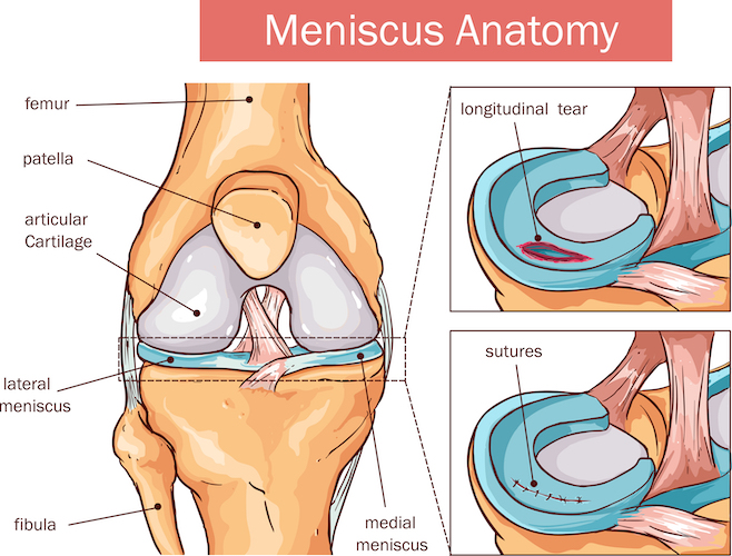 Meniscus Tear Treatment in Visalia Is Our Specialty