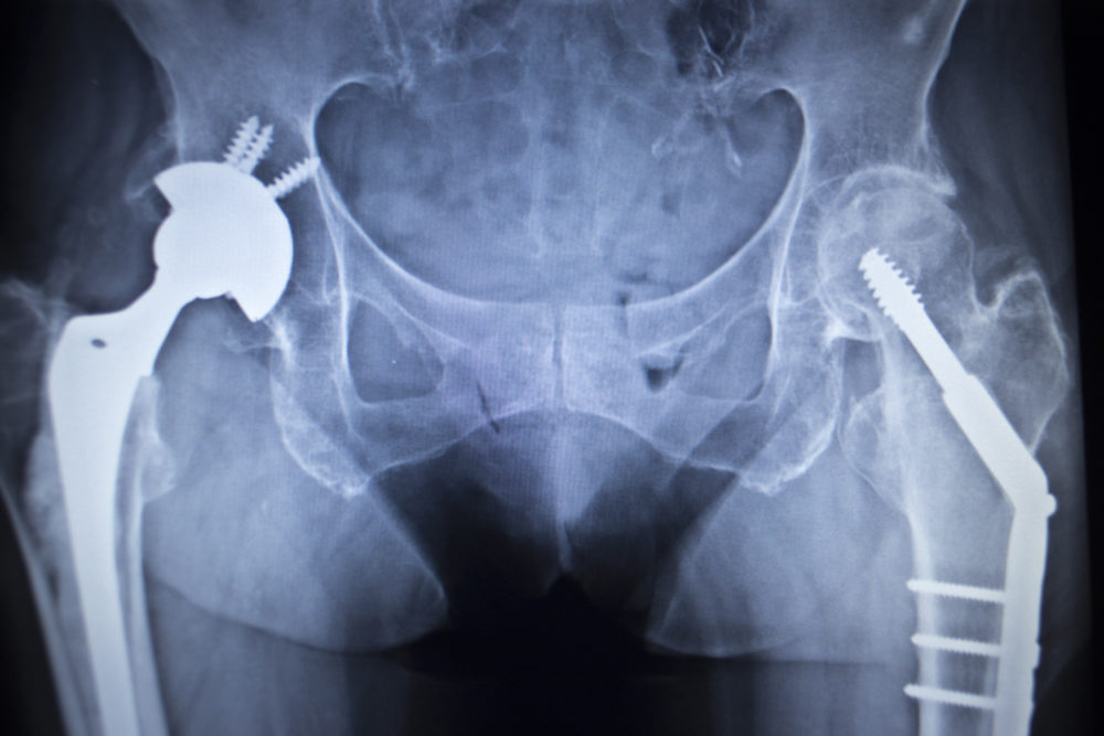 Hip Replacement Rehabilitation in Visalia